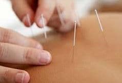 Acupuncture